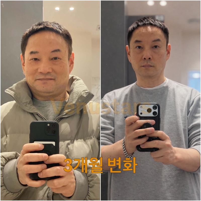 캐비초크 3개월 전후 비교 — 김태웅 씨 실제 다이어트 후기